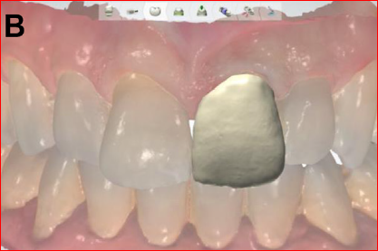 provisional restoration reference