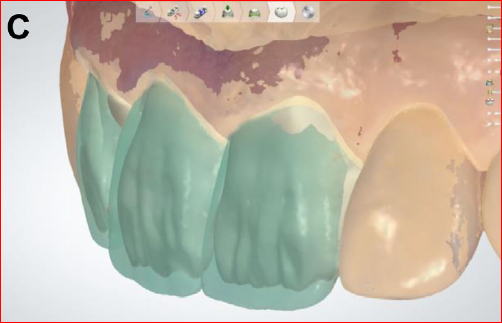 trial restoration reference